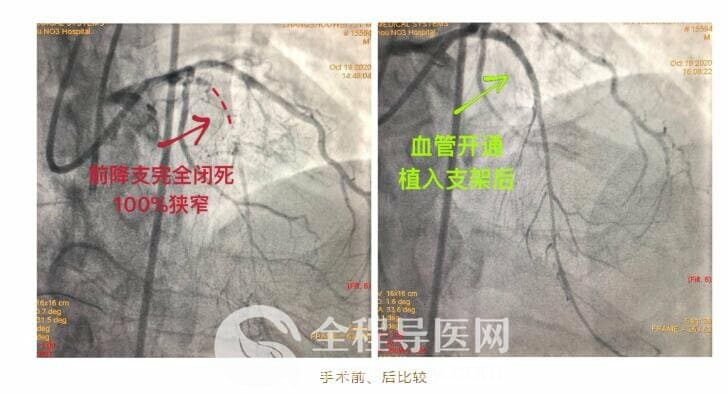 徐州市三院心臟團隊于長城心臟病學(xué)大會CTO論壇直播超高難度冠心病介入手術(shù)